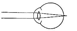 FIG. 79.—The farsighted eye.