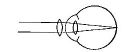 FIG. 80.—The defect is remedied by convex glasses.