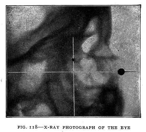 FIG. 118–X-RAY PHOTOGRAPH OF THE EYE